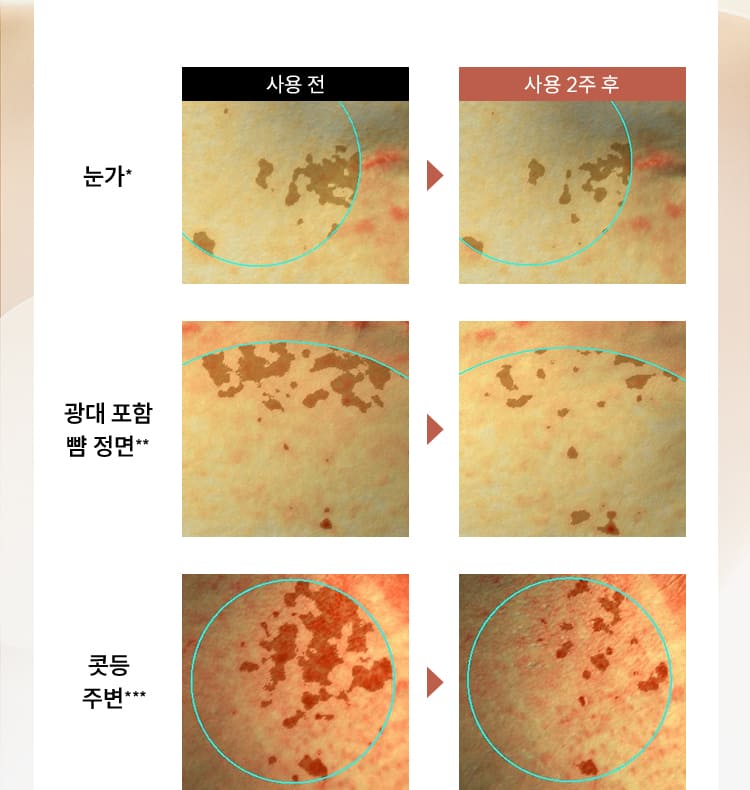 눈가*, 광대 포함 뺭 점면**, 콧등 주변*** 사용전 > 사용 2주 후 비교