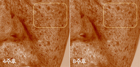 한율 백화고 기미단 크림 사용 4주 후와 사용 8주 후 비교. 기미와 잡티가 줄어든 모습