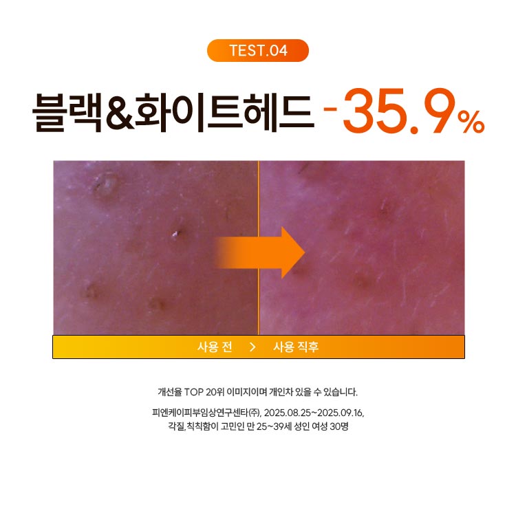 TEST.04 블랙&화이트헤드 -35.9%: 개선율 TOP 20위 이미지이며 개인차 있을 수 있습니다. 피엔케이피부임상연구센타(주), 2025.08.25~2025.09.16 블랙&화이트헤드, 묵은각질이 고민인 만 25~39세 여성 30명
